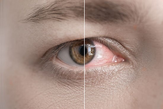 Causas del síndrome del ojo seco