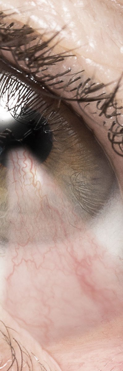 Pterigión efectos vista