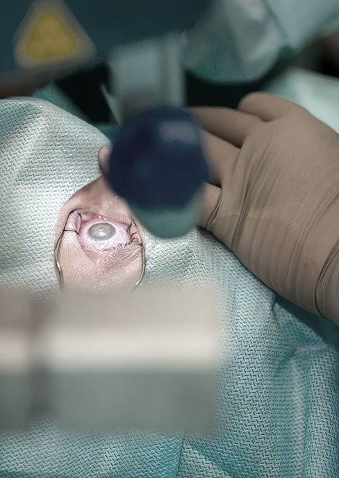 intervención de cataratas