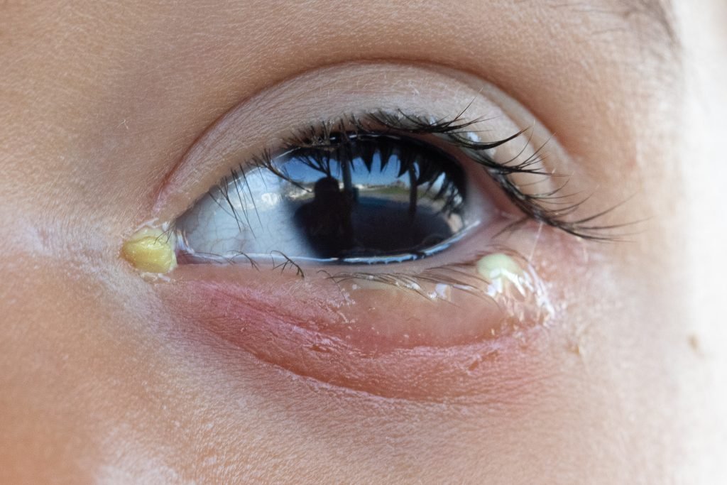 conjuntivitis bacteriana