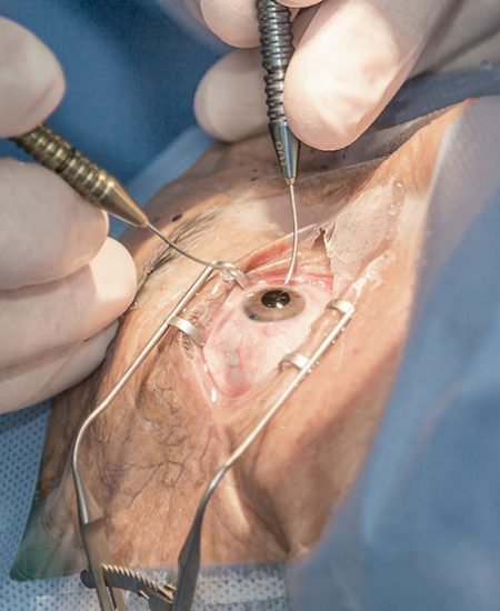 Cataratas lente intraocular