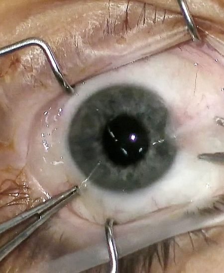 Cirugía Pterigión Dr. Peraza